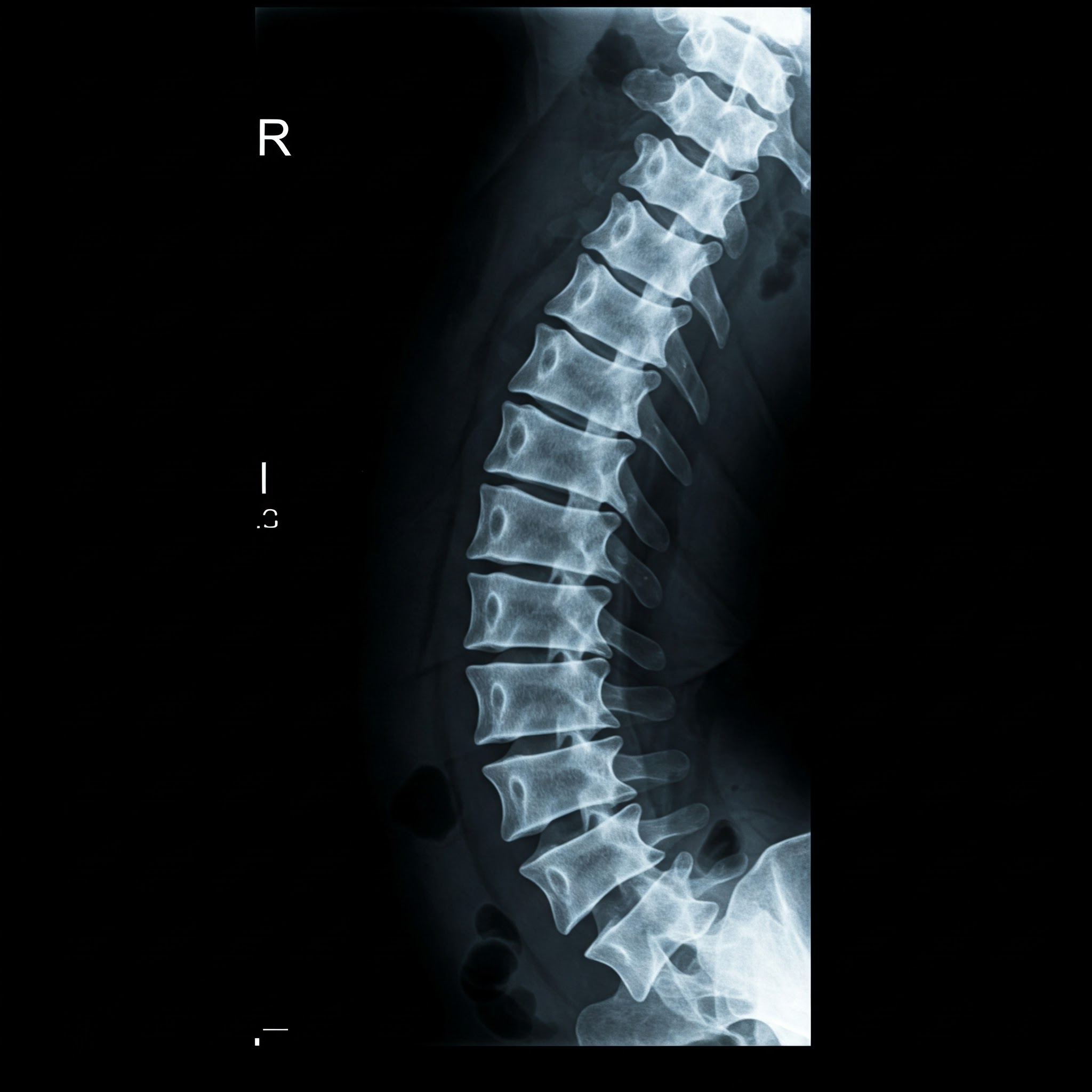 LUMBOSACRAL SPINE X-RAY
