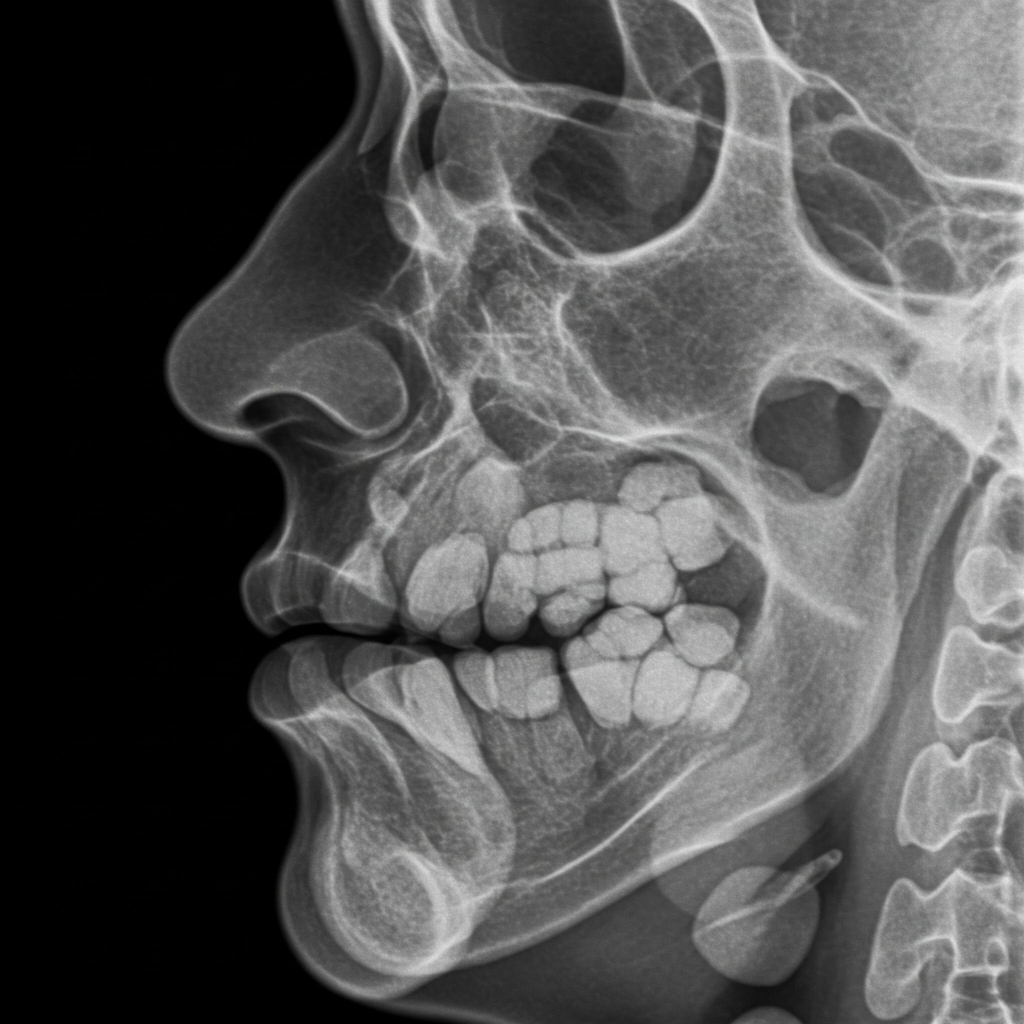 SINUS X-RAY